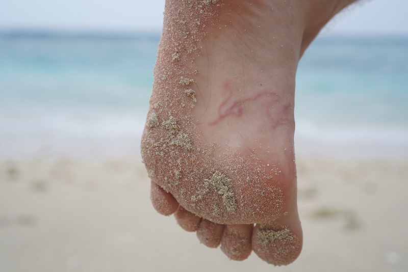 hookworms Zanzibar hookworms Zanzibar